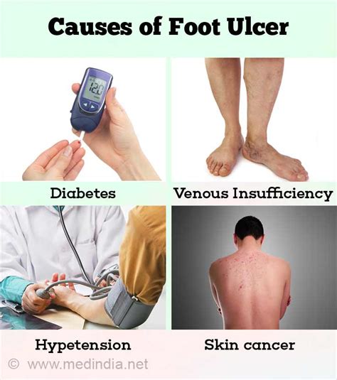 Diabetic Foot Ulcer Causes