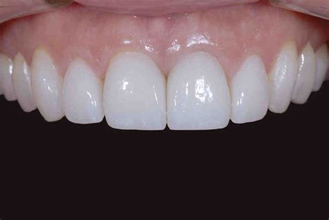 Cosmetic dentistry chicago crowns - Dental News Network