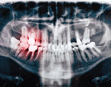 Dental x-ray | Arch Dental