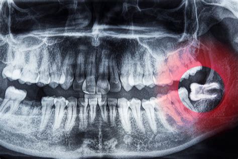 Everything You Ever Wanted to Know About Wisdom Teeth - Dr. Elston Wong ...