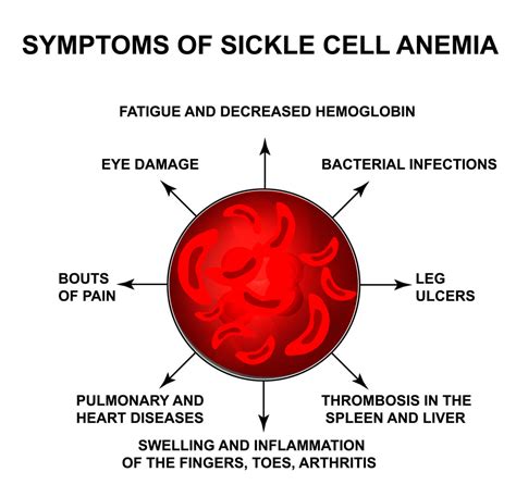 Sickle Cell Anemia and Vision | National Sickle Cell Month - Kadrmas ...