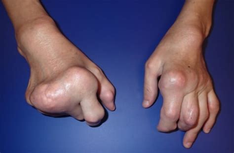 Deformities of the Hand | Hand Surgery Associates