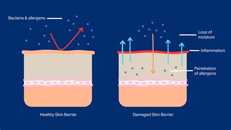 Skin Barrier Basics for People With Eczema | National Eczema Association