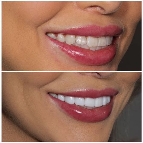 Porcelain Veneers Brisbane [Free Consult] | Smiling Dental