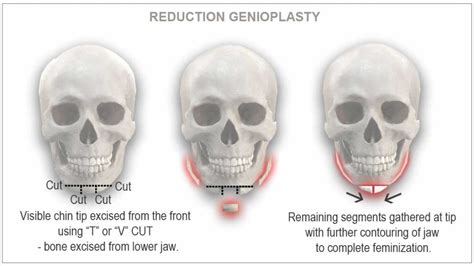 Genioplasty (Chin Surgery): Types, Complications, And, 50% OFF