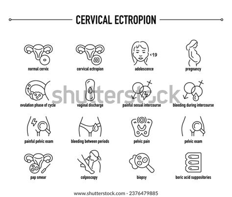 Cervical Ectropion Symptoms Diagnostic Treatment Vector Stock Vector ...