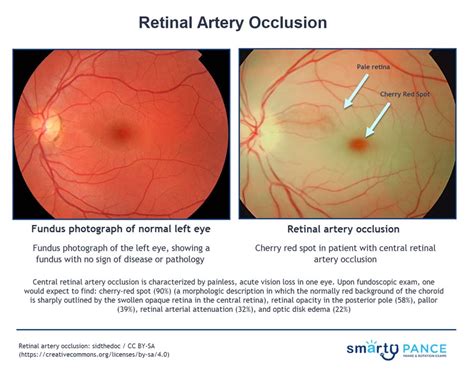 Central Retinal Artery Occlusion Anatomy