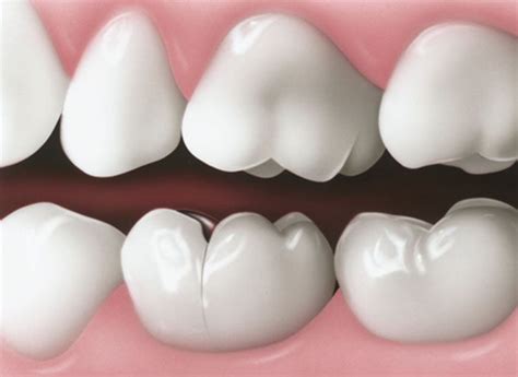 What Do I Do If I Have a Cracked Tooth? | Taree Dental Care