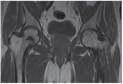 Avascular Necrosis Of Femoral Head Mri