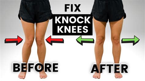 Matchless Tips About How To Correct Knock Knees - Dancelocation19