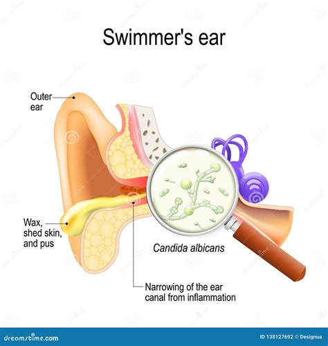 Otitis. Swimmer`s Ear is Inflammation of the Ear Canal and Fungal ...