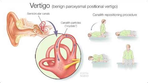 Mayo Clinic Q and A: Dizziness Caused by Inner Ear Crystals - Mayo ...