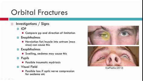 Orbital Floor Fracture Symptoms – Two Birds Home