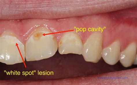 Saginaw dentist talks about pop drinking and cavities | Mead Family Dental