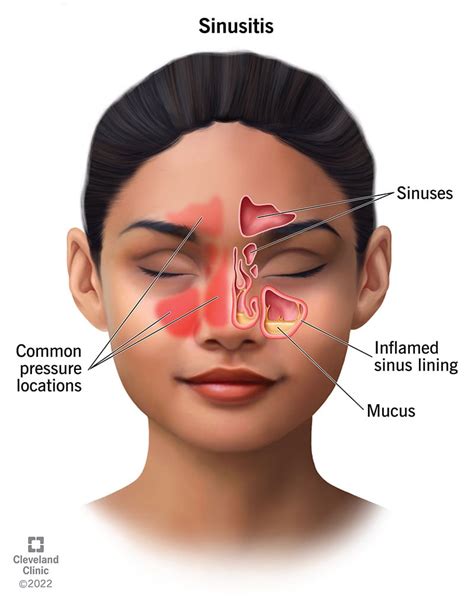 Sinus Infection (Sinusitis): Causes, Symptoms Treatment | atelier-yuwa ...