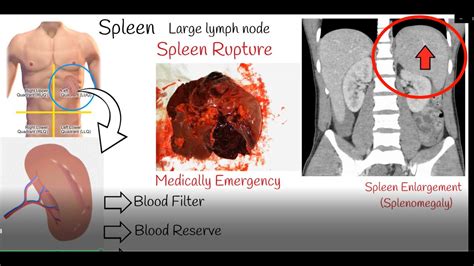 Spleen pain, Spleen enlargement and Spleen rupture. Causes and ...