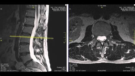 Lower Back Mri Lumbar Spine