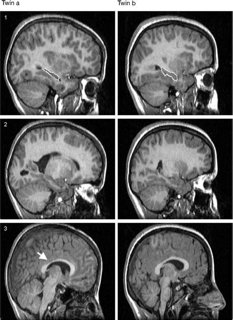 High-resolution T1-weighted images. (1) Hippocampus atrophy ...