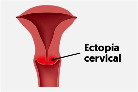 Tratamiento para curar el ectropión/ectopia cervical - Tua Saúde