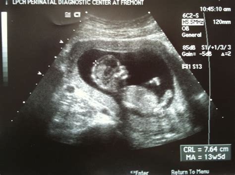 Athena's Chateau: 2nd Nuchal Translucency Ultrasound, 5/11/2011