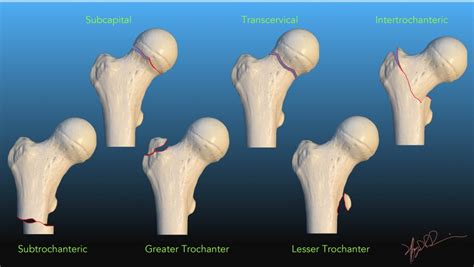 Femoral Neck Fracture Nomenclature | UW Emergency Radiology