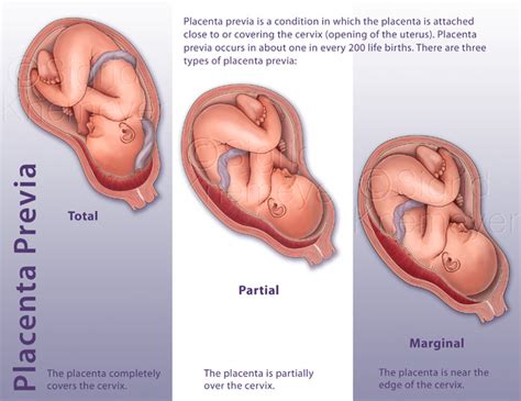 Placenta previa