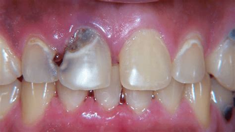 Cavity on front tooth: Why do we get it? | ILAJAK Medical