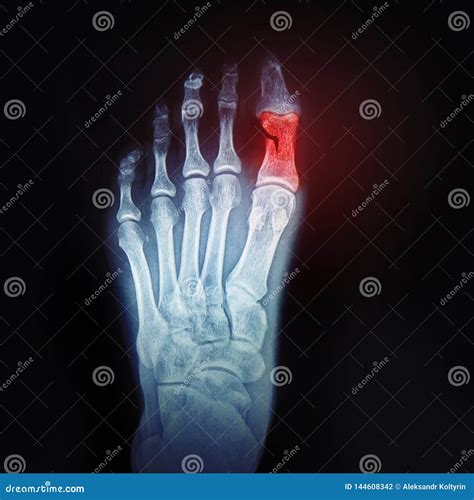 A Broken Toe. X-ray of the Foot with the Designation of the Sore Spot ...