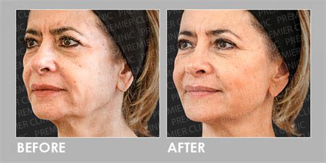 Ellanse Dermal Filler - Sagging Skin Treatment - Premier Clinic