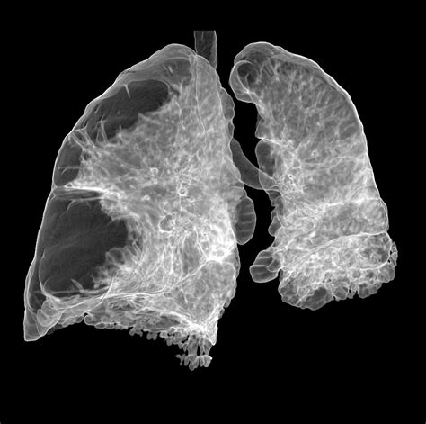 Acute Exacerbations of COPD May Impact Lung Density in AATD