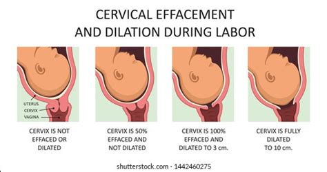 Vector Cervical Effacement Dilatation During Labor: vetor stock (livre ...