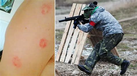 How to Treat & Prevent Paintball Bruises and Welts 2024