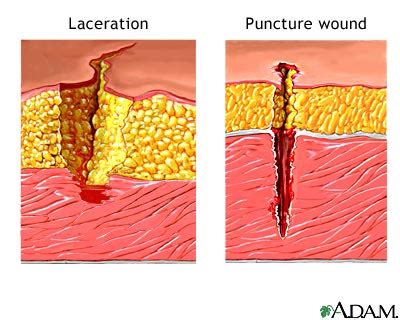 Laceration. Causes, symptoms, treatment Laceration