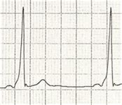 Delta Wave • LITFL Medical Blog • ECG Library Basics