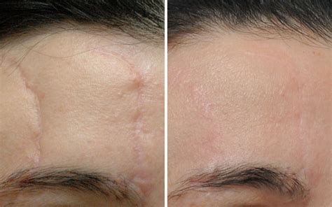 Scar Removal Before & After Photos Annapolis MD