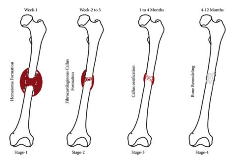 The stages of healing of bone fracture. | Download Scientific Diagram