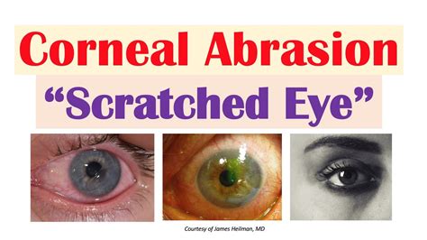 Eye Cornea Damage Symptoms - Infoupdate.org