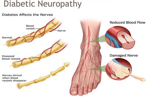 Understanding Diabetic Neuropathy And Common Symptoms Painscale | Porn ...