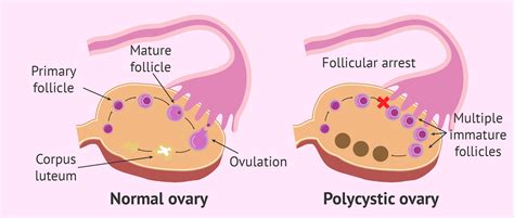 Polycystic Ovary Syndrome (PCOS) and It's Symptoms | Polycystic ovary ...