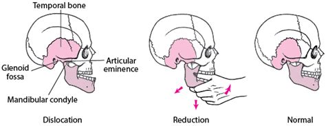 Jaw Dislocation - Mouth and Dental Disorders - MSD Manual Consumer Version