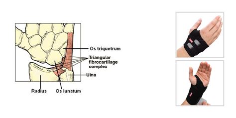 TFCC Ulnar Sided Wrist Pain Anatomy, Diagnosis Treatment, 53% OFF