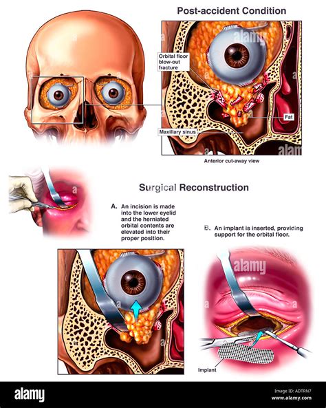 Orbital Floor Out Fracture Surgery - Carpet Vidalondon