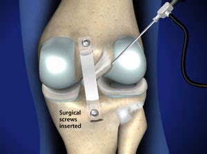 Posterior Cruciate Ligament (PCL) Reconstruction in Plano, Frisco ...