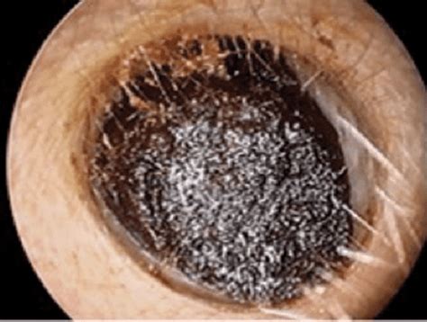 Figure 1 from Clinical Practice Guideline (Update): Earwax (Cerumen ...