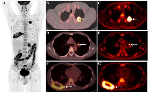 Lung Cancer Cat Scan