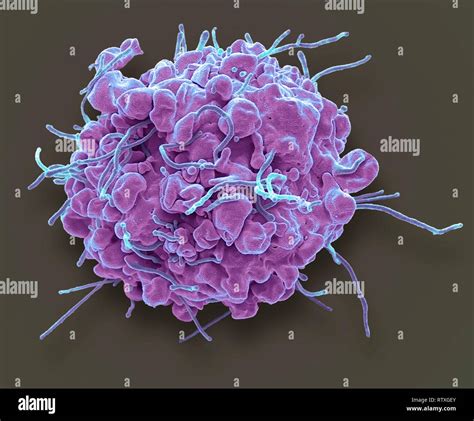 Apoptosis. Coloured scanning electron micrograph (SEM) of a 293T cell ...