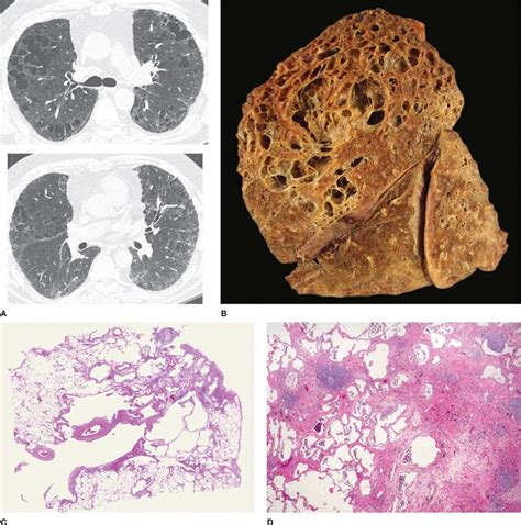 Pathology of Chronic Obstructive Pulmonary Disease: Diagnostic Features ...