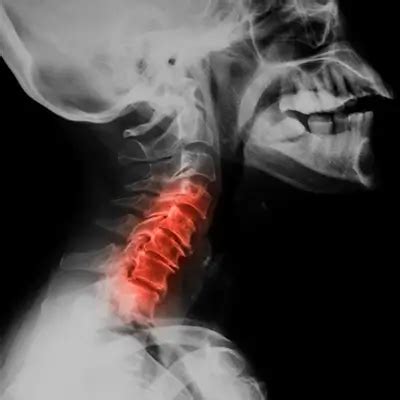 Cervical Spine Osteoarthritis: Symptoms & Prevention - Innovative ...