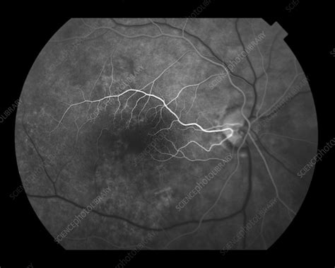 Cilioretinal Artery - Stock Image - C027/1323 - Science Photo Library