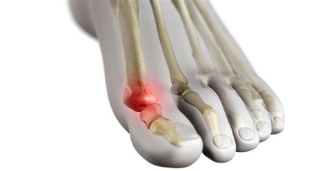 Turf Toe Injury (Metatarsophalangeal Joint Sprain)